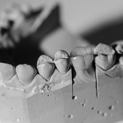 crown-bw dental bridge