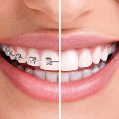 teeth-whitening-colour