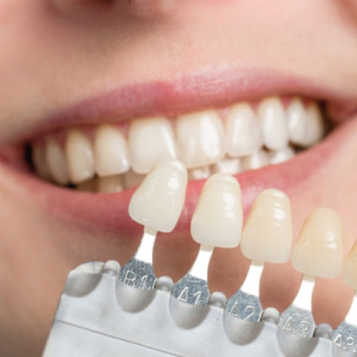 teeth-whitening-colour