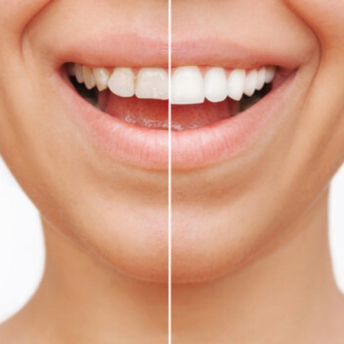 teeth-whitening-colour